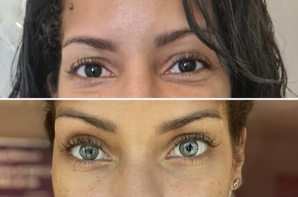 Πρώτη επιτυχημένη επέμβαση αλλαγής χρώματος ματιών στην Ελλάδα