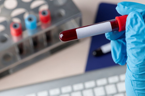 «Πράσινο» και από τον FDA σε εξέταση αίματος για το Αλτσχάιμερ