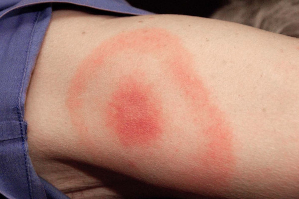 Νόσος Lyme: Η κούρσα των επιστημόνων για νέα εμβόλια και θεραπείες