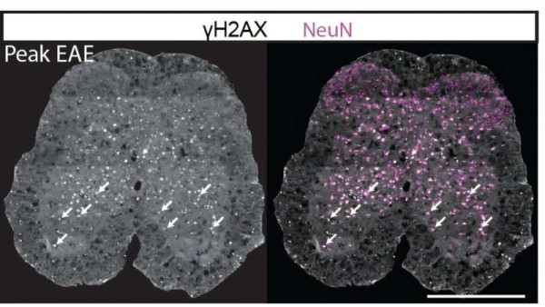 Σκλήρυνση κατά πλάκας: Ερευνητές εντόπισαν διαδικασία κυτταρικού θανάτου που παίζει ρόλο στην καταστροφή των νευρώνων