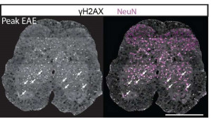 Σκλήρυνση κατά πλάκας: Ερευνητές εντόπισαν διαδικασία κυτταρικού θανάτου που παίζει ρόλο στην καταστροφή των νευρώνων