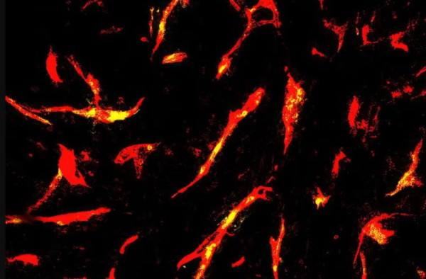 Θεραπεία με CAR-T κύτταρα στοχεύει δύσκολα θεραπεύσιμους συμπαγείς όγκους