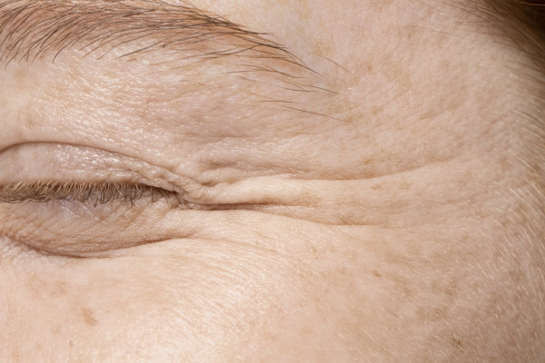 Το "πόδι της χήνας" στα μάτια μπορεί να προειδοποιεί για κίνδυνο Αλτσχάιμερ