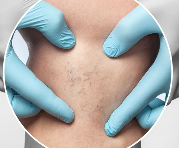 Σκληροθεραπεία: Μια αξιόπιστη λύση για την εξάλειψη των ευρυαγγειών