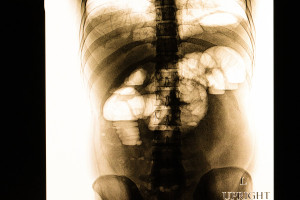 Ειλεός: Όταν το γαστρεντερικό σύστημα «φράζει» - Τα συμπτώματα, τα αίτια και η αντιμετώπιση