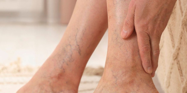 Τι είναι οι κιρσοί στα πόδια και γιατί πρέπει να χειρουργηθούν