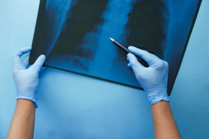 Προς έγκριση τρεις νέες θεραπευτικές επιλογές για τον καρκίνο του πνεύμονα και των ωοθηκών