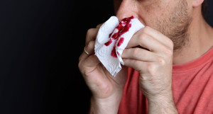 Ρινορραγία: Τι μπορεί να μας «δείχνει» η απώλεια αίματος από τη μύτη