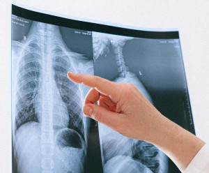 Καρκίνος του πνεύμονα: Η εξάπλωσή του σε άλλα μέρη του σώματος και τα ποσοστά επιβίωσης